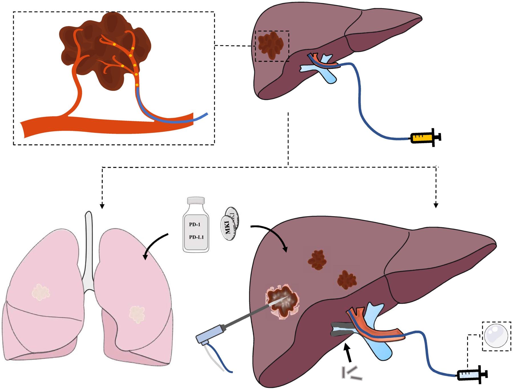 Transarterial Radioembolization